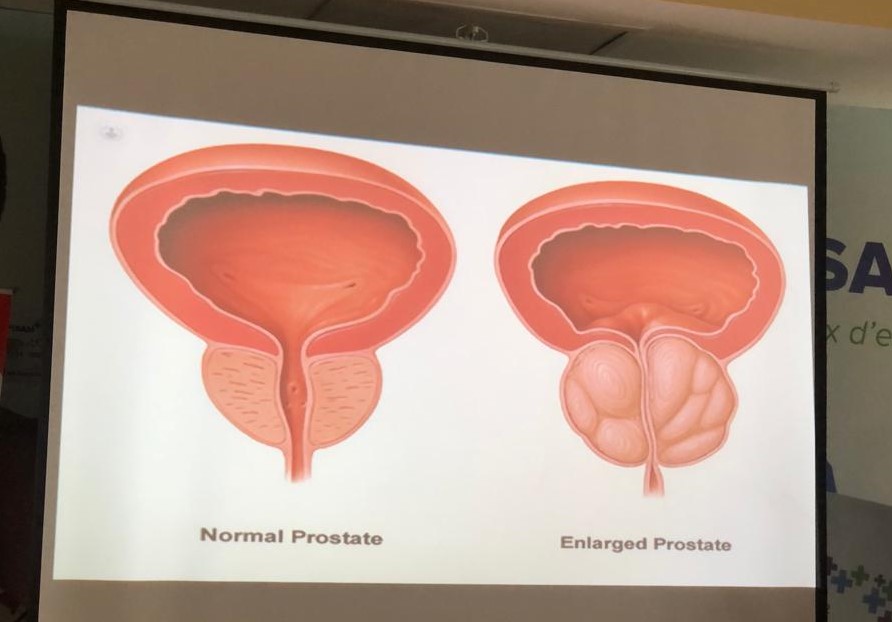 Cancer de la prostate / Il faut au moins 21 éjaculations par mois pour protéger sa prostate