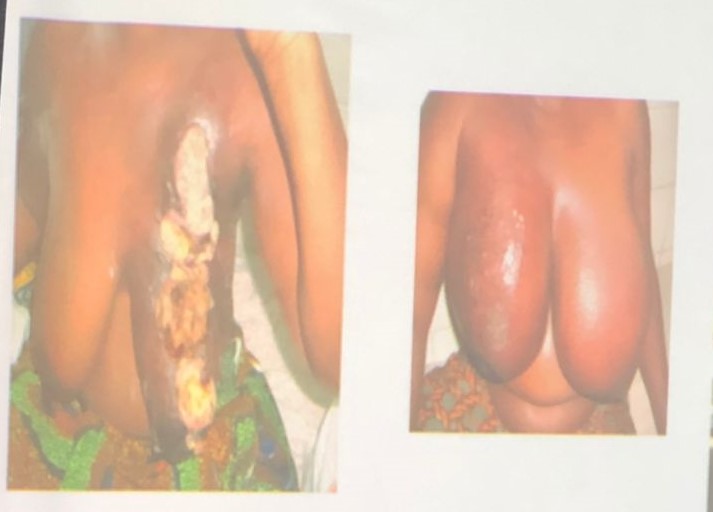 Cancer du sein / 50% de réduction pour la radiothérapie et chimiothérapie au CNRAO